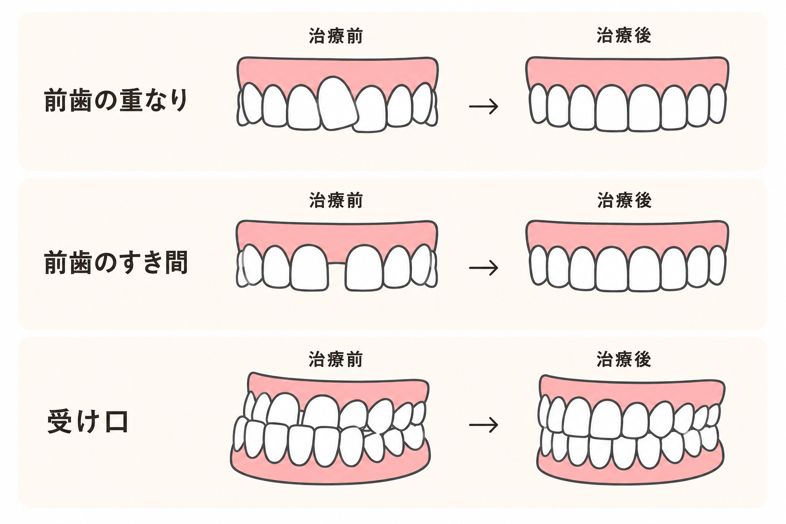 前歯の重なり、前歯のすき間、受け口の治療前後を示した説明図